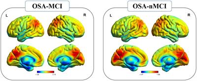Inherent regional brain activity changes in male obstructive sleep apnea with mild cognitive impairment: A resting-state magnetic resonance study